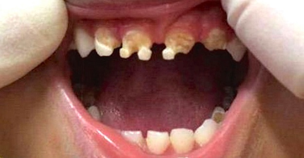 Diş Doktoru Bu İçeceği Çocuklarınıza Kesinlikle Vermeyin Diye Uyardı
