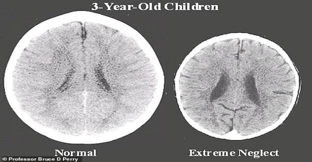 İlgiyle büyüyen bir çocuk ile ilgisiz büyüyen bir çocuğun beyin gelişimi arasındaki fark