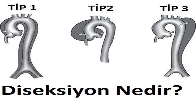 Diseksiyon Nedir? Diseksiyonun Tanımı Nedir?